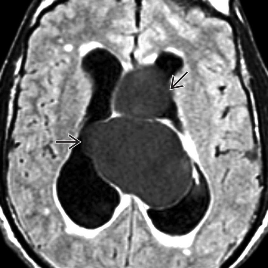 Axial FLAIR MR shows neurocysticercosis resulting in IVOH. Large intraventricular cysts are present in the lateral vents , obstructing the foramina of Monro.