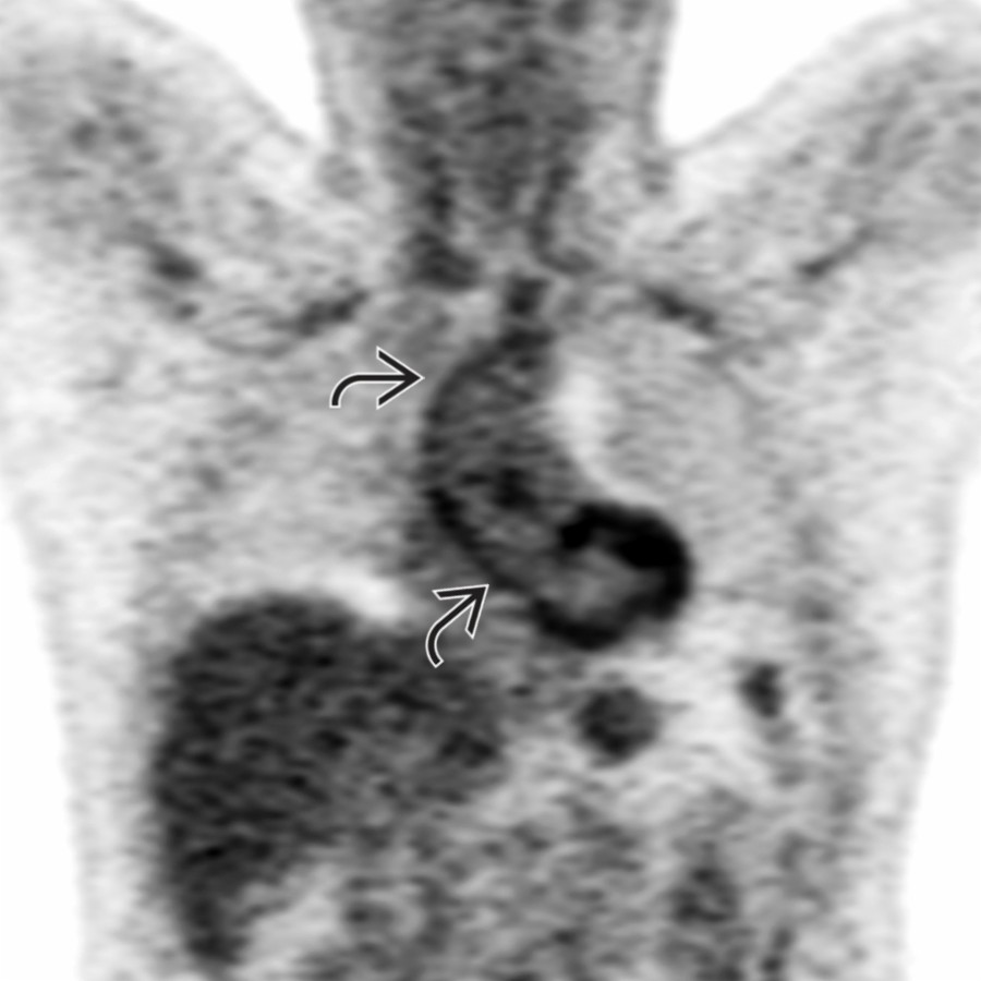 Coronal FDG PET/CT in the same patient shows marked uptake of FDG along the ascending aortic wall . FDG PET has excellent sensitivity and specificity for the diagnosis of GCA and may be used when clinical or serological discrepancies arise during or after treatment of this condition.
