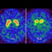123FP-CIT-SPECT, DAT imaging (dopamine transporter) shows normal symmetric uptake in the striatum  of a healthy control (HC). In DLB, there is marked ↓ update in the putamen   & mild in the caudate nuclei . Using DAT imaging, it is not possible to distinguish DLB from atypical parkinsonian syndromes like MSA, PSP, & CBD.