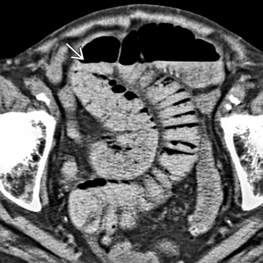 Axial CECT at higher level in the same patient reveals a small bowel obstruction .