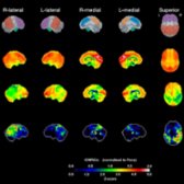 Stereotaxic surface projection in AD shows mild hypometabolism in the temporal lobes and especially diminished in the parietal lobes . The Z-score map demonstrates the hypometabolism  very well. (Courtesy N. Foster, MD.)