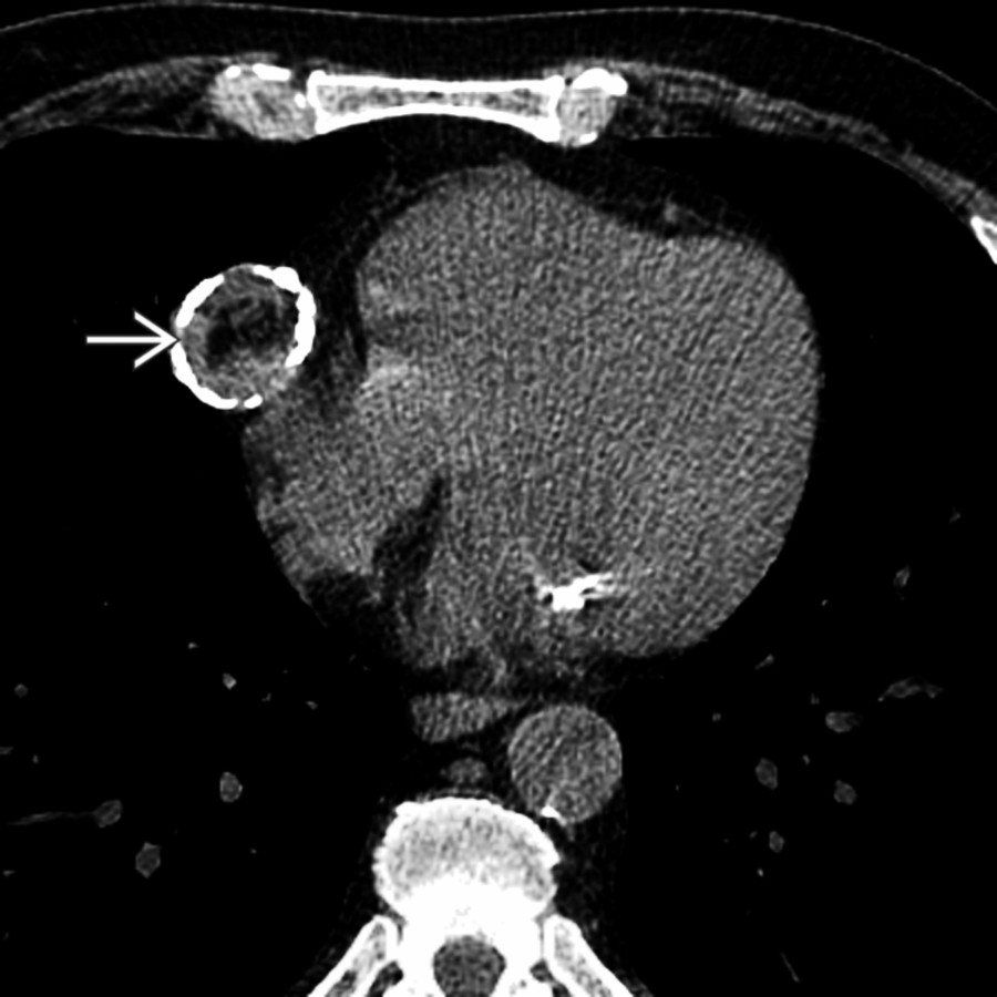 Axial NECT shows well-circumscribed mixed fat and soft tissue adjacent to the pericardium . This was thought to be a teratoma.