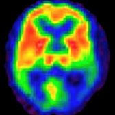 FDG PET in the same patient shows a decreased rate of glucose metabolism in the posterior aspects of both temporal lobes, typical of AD. (Courtesy N. Foster, MD.)