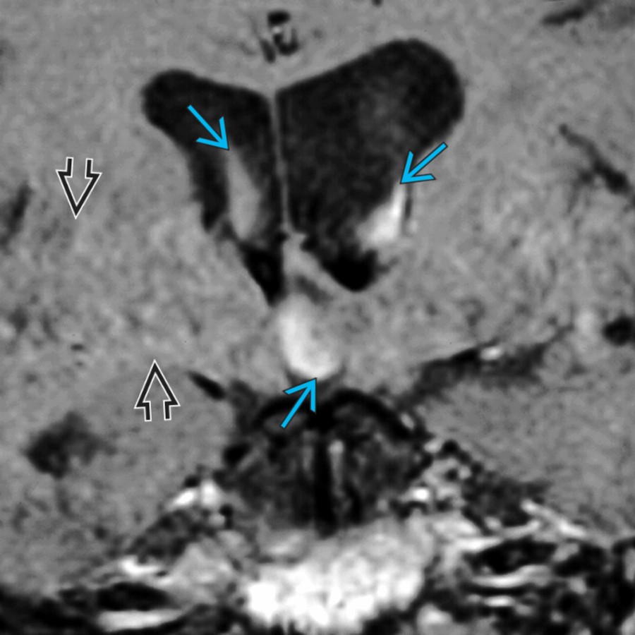 Coronal T1WI MR shows prominent pseudomasses of the 3rd and lateral ventricles  caused by pulsatile CSF in and around the interventricular foramen (of Monro). Note the propagation of phase artifact  across the image.