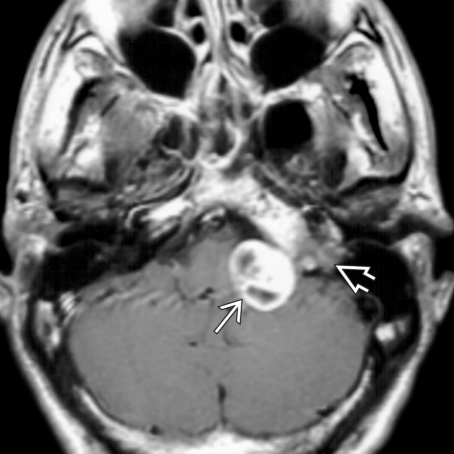 Axial T1 C+ MR demonstrates an ovoid enhancing mass in the low CPA cistern . Multiple intramural cysts suggest the diagnosis of schwannoma. Extension into the jugular foramen    is evident.