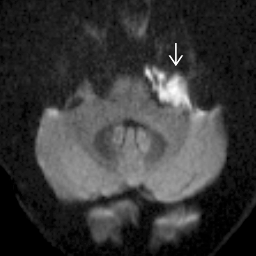 Axial DWI MR in a patient with chronic left HFS shows a left CPA mass  with reduced diffusivity and scalloped, insinuating margins, typical of an epidermoid cyst.