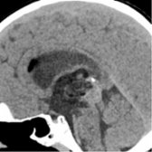 Sagittal NECT shows a heterogeneous mass with fat  and calcification  in the pineal region extending to the 3rd ventricle, consistent with mature teratoma. There is a small amount of intraventricular air    from recent biopsy.