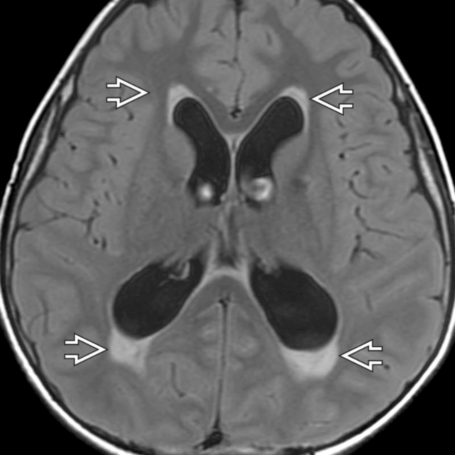 Axial FLAIR MR through the lateral ventricles in the same child shows transependymal edema capping the frontal and occipital horns , reflecting the increased pressure in the ventricular system.