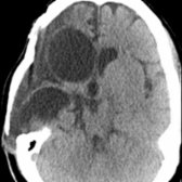 Axial NECT shows changes of a remote right-sided craniotomy with right frontotemporal encephalomalacia  and atrophy of right cerebral peduncle  due to antegrade WaD. Also note ex vacuo dilation of right lateral ventricle .