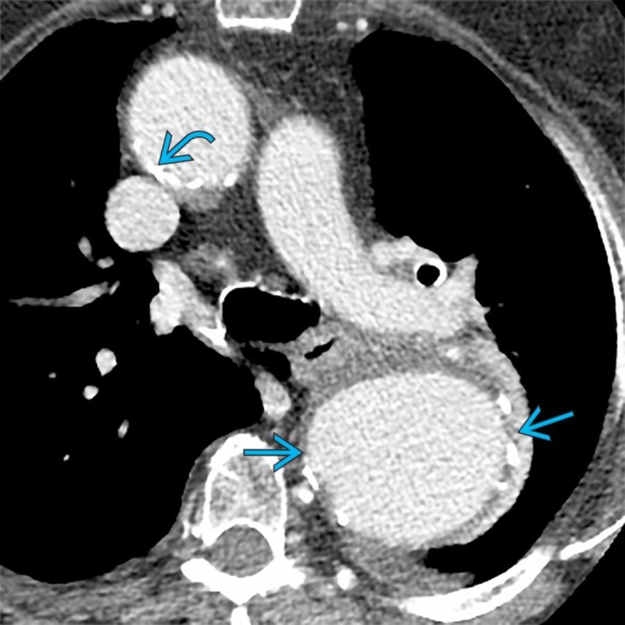 Axial CECT of the same patient shows aneurysm of the descending thoracic aorta  and calcified  and noncalcified atherosclerotic disease of the aorta. Atherosclerosis is the most common cause of aortic dilation.