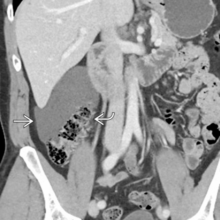 Coronal CECT demonstrates a cystic lymphangioma  wrapped around the margins of the right colon  but without any associated mass effect.