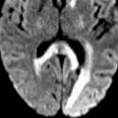 Axial DWI in a patient with recent infarcts in the left occipital lobe  and left internal capsule  show restricted diffusion restriction along splenium , indicating WaD.