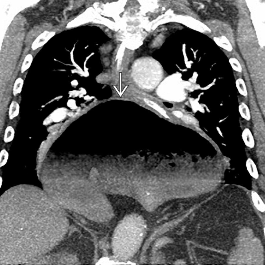 Coronal CECT shows a large hiatal hernia with the entirety of the stomach  located within the thoracic cavity.