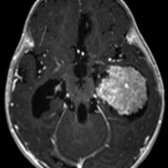 Axial T1 C+ MR shows a frond-like mass within the left temporal horn, consistent with a choroid plexus papilloma . Choroid plexus tumor locations follow larger volumes of choroid: Lateral ventricle > 4th > 3rd.
