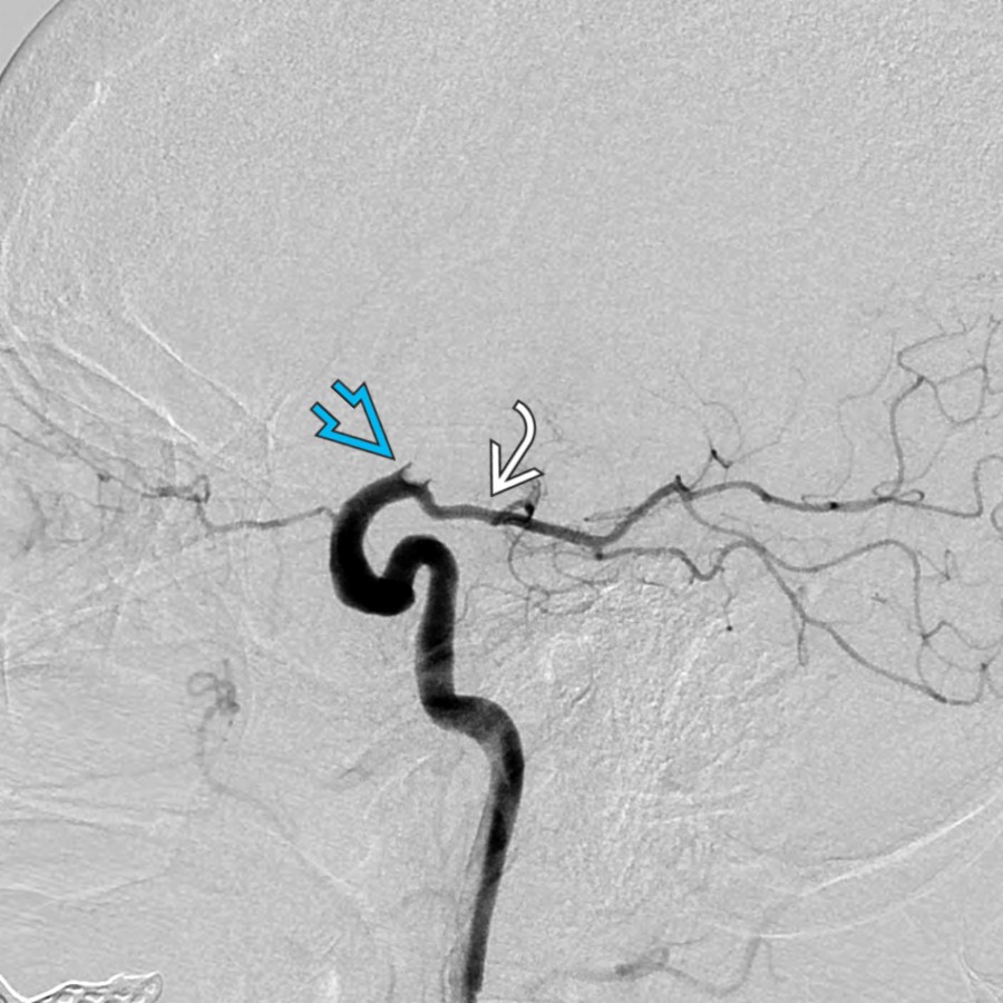 Lateral DSA demonstrates a filling defect within the distal left ICA , consistent with acute thromboembolus. There is no filling of the left ACA or MCA. The left posterior communicating artery  is patent.