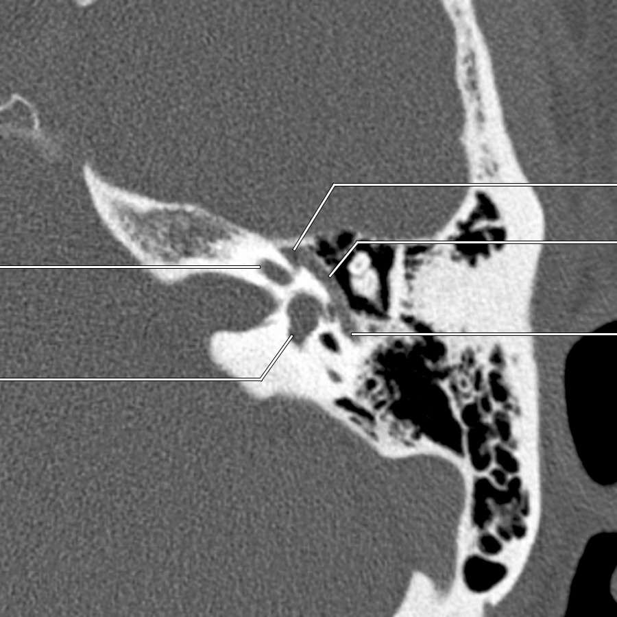 In this image, the labyrinthine segment of CNVII canal terminates in the geniculate fossa. The facial nerve canal turns abruptly at the geniculate fossa (anterior genu). The tympanic segment arises from the geniculate fossa, coursing posterolaterally in the axial plane, running under the lateral semicircular canal before turning 90° inferiorly at the posterior genu to become the mastoid segment.