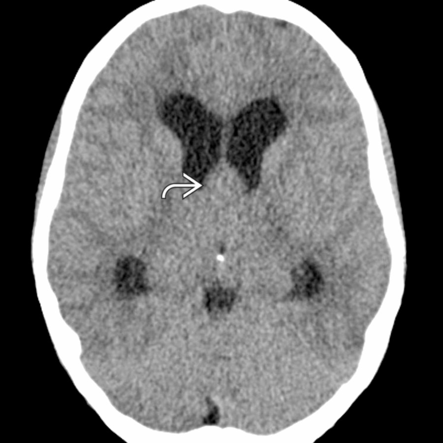 An isoattenuating colloid cyst  obstructs the foramina of Monro in this 7-year-old, causing obstructive hydrocephalus.