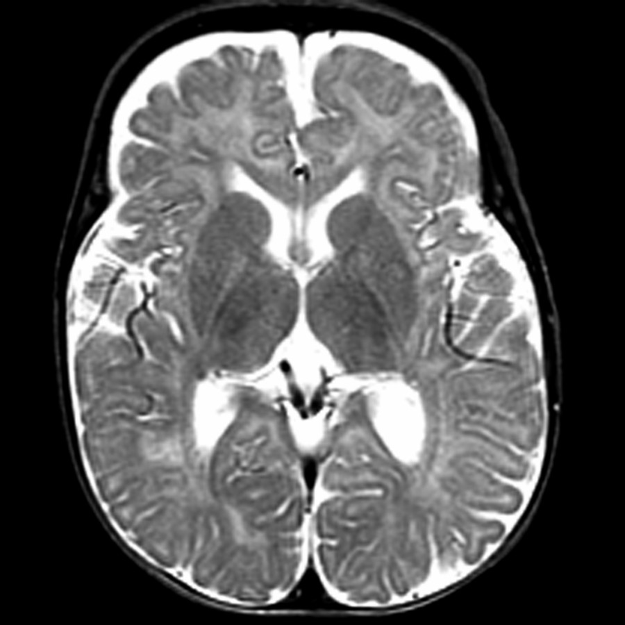 Axial T2 MR shows prominent frontal CSF spaces (craniocortical & interhemispheric) with mildly prominent ventricles in this macrocephalic infant. Note the squaring of the forehead, seen clinically as "frontal bossing." About 20-50% of cases have mild developmental delay (motor > > language), which nearly always resolves without therapy.