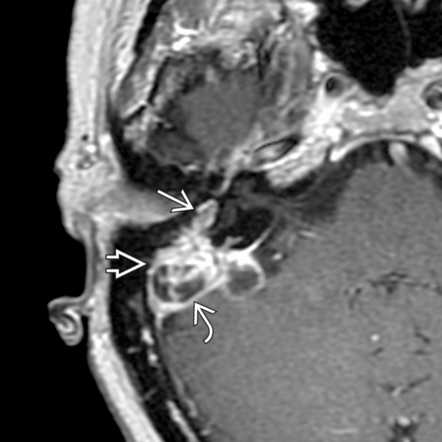 Axial T1 C+ MR shows an aggressive schwannoma involving the tympanic segment , posterior genu , and descending mastoid segment of the right facial nerve. Note several nonenhancing intramural cysts .