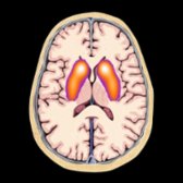Axial graphic shows normal uptake (orange) of I-123 ioflupane or F-18 FDOPA overlaid on the head of the caudate  and putamen .