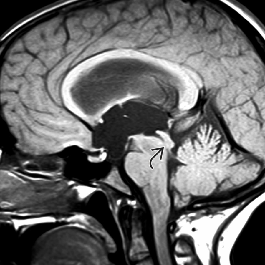 Sagittal T1 MR shows IVOH secondary to aqueductal stenosis and distal stenosis of cerebral aqueduct . Note the enlarged lateral and 3rd ventricles.