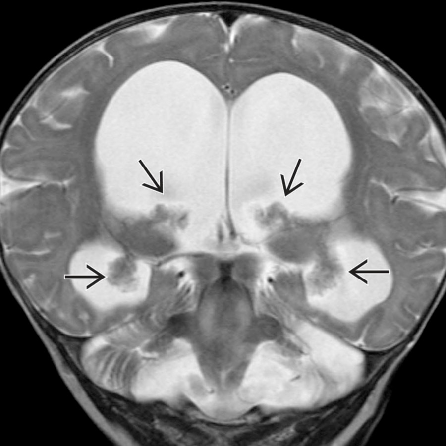 CSF overproduction can rarely be nonneoplastic in nature, as in this 6-month-old with villous hyperplasia of the choroid plexus in each lateral ventricle . Note the preservation of peripheral sulci, as the unfused sutures of the infant can widen in response to increased intracranial volume.