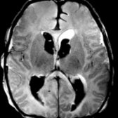 Axial T2WI in the same patient shows increased T2 signal in bilateral frontal and right occipital lobes  corresponding to acute infarcts. Subtle hyperintense signal in genu  & splenium  is difficult to assess due to high water content in the neonatal brain.