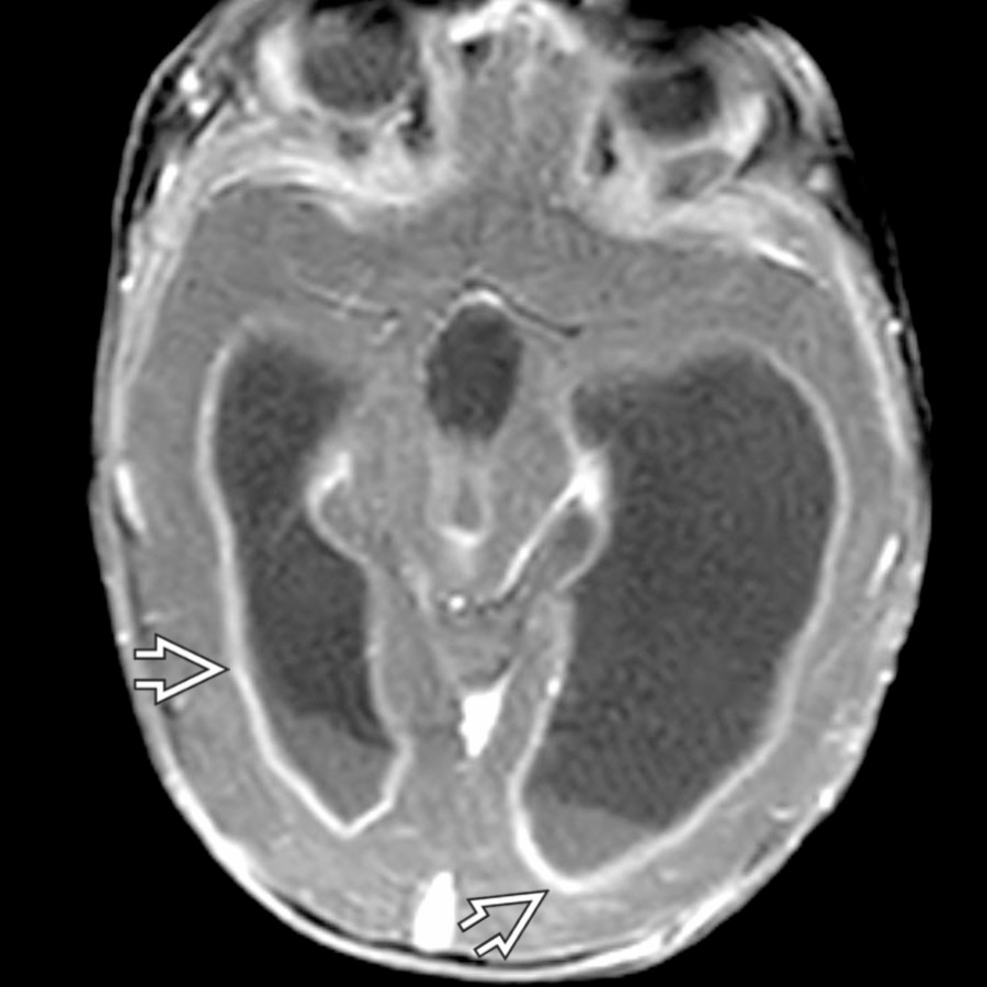 Bacterial meningitis (group A Streptococcus in this example) can restrict resorption of CSF but can also obstruct at the cerebral aqueduct and 4th ventricular outlets when complicated by ventriculitis, evident on this image by abnormal enhancement of the ependyma .