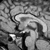 Sagittal T1WI MR reveals a small anterior pituitary gland and ectopic posterior pituitary bright spot  located along tuber cinereum. Pituitary stalk is absent in this 2 year old with growth failure.