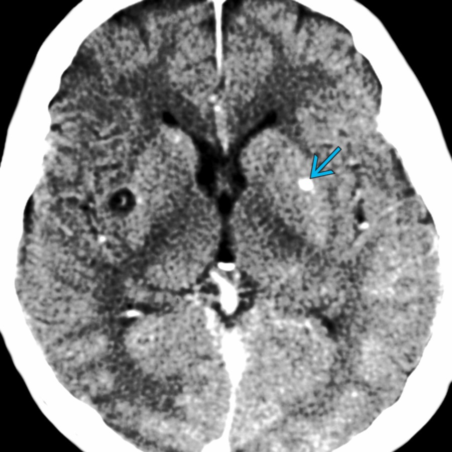 Axial CECT shows a calcified left putamen nodule  that represents the nodular, calcified (healed) stage of neurocysticercosis. Note the right external capsule cyst with a central "dot" representing a scolex.