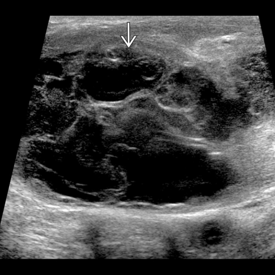 Longitudinal US in a patient with groin swelling after catheterization shows a large, complex hematoma  with internal echoes and mixed echogenicity.