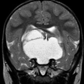 Coronal T2 MR in 2-year-old child shows a huge cyst with intra-  and suprasellar  components. A large Rathke cleft cyst was found at surgery.