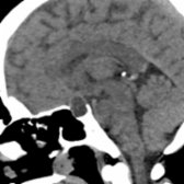 Sagittal NECT in a patient with a headache shows a hypodense, intrasellar mass with mild suprasellar extension , a typical CT appearance of Rathke cleft cyst. Note the lack of calcification, which helps distinguish RCC from craniopharyngiomas, which are typically calcified (90%).