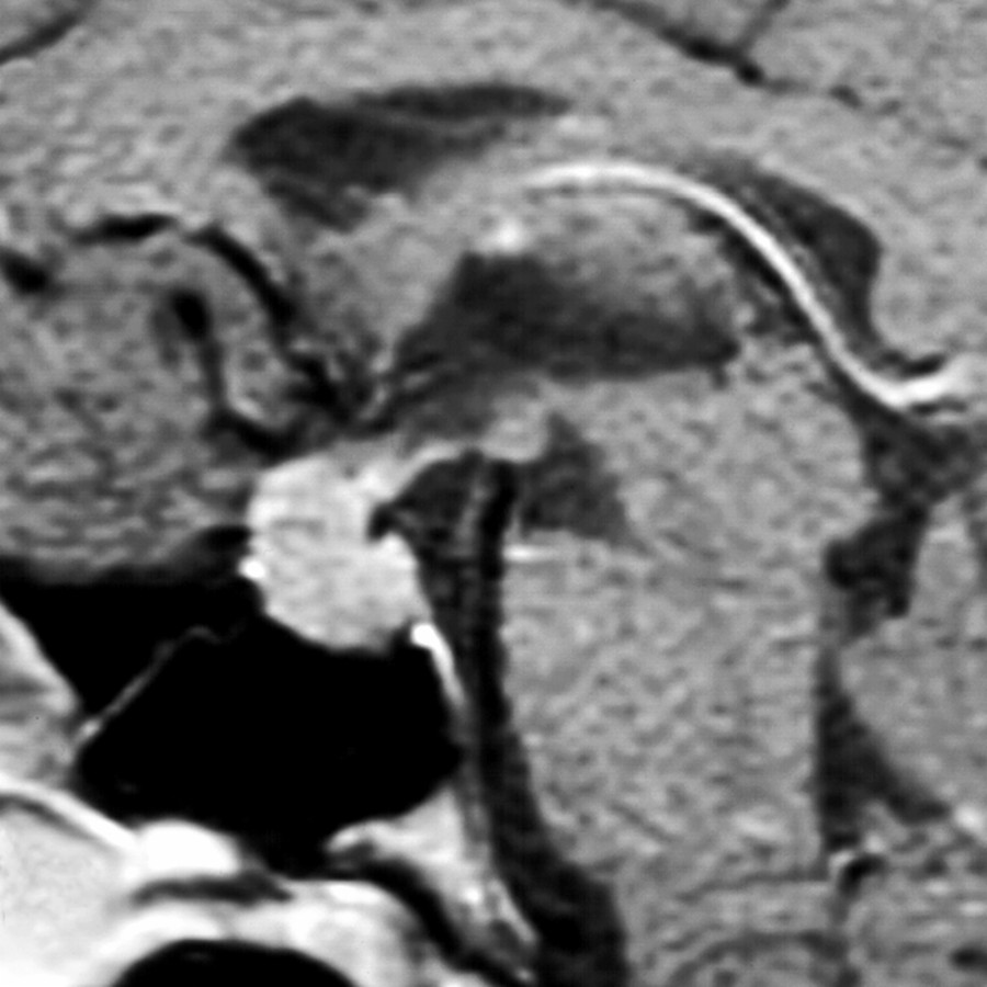 Sagittal T1 C+ MR in the same patient shows diffuse enhancement of the suprasellar mass, similar to the adjacent pituitary gland. Biopsy proved pituicytoma. (Courtesy B. Chong, MD.)