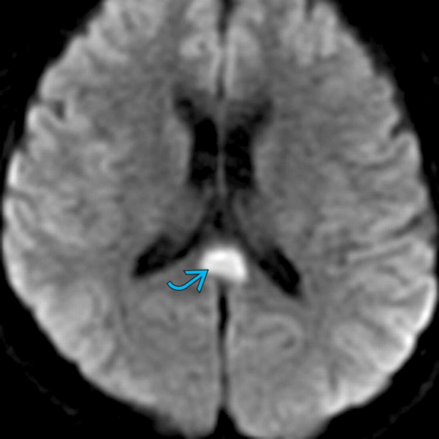 Axial DWI MR shows restricted diffusion in the splenium of the corpus callosum . Follow-up MR showed complete resolution. A transient splenial lesion can be seen with seizures, antiepileptic medications, PRES, viral infections, and hypoglycemia.