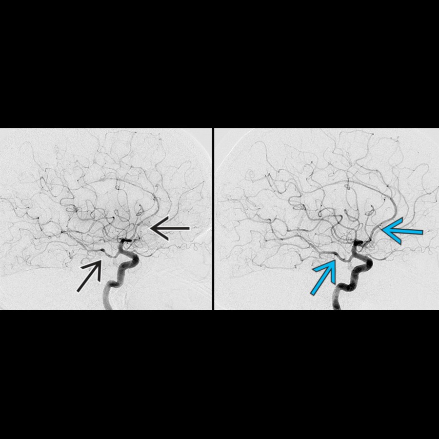DSA in the same patient shows multifocal narrowing  on the initial ICA injection. Following Verapamil injection, there is reversal of the multifocal narrowing  with a more normal caliber of the intracranial vasculature, compatible with RCVS.
