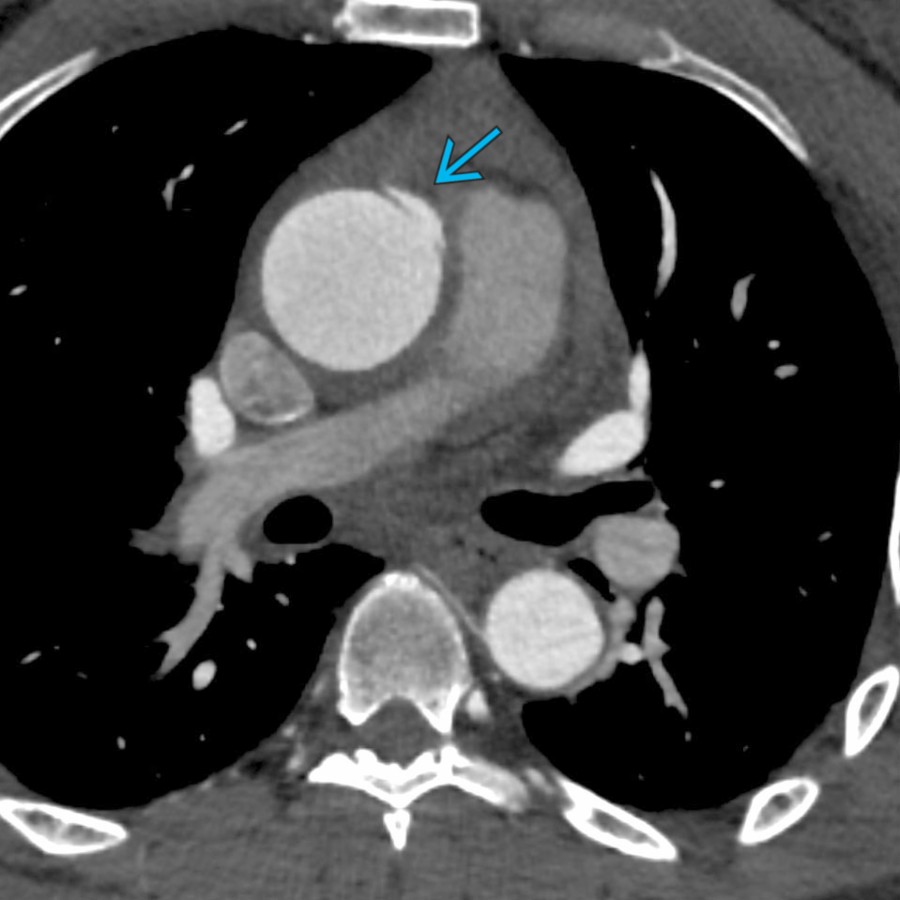 The proximal end of the LIT shows the undermined edge, reminiscent of a dissection, seen on the left aspect of the ascending thoracic aorta . (Courtesy S. Kligerman, MD.)