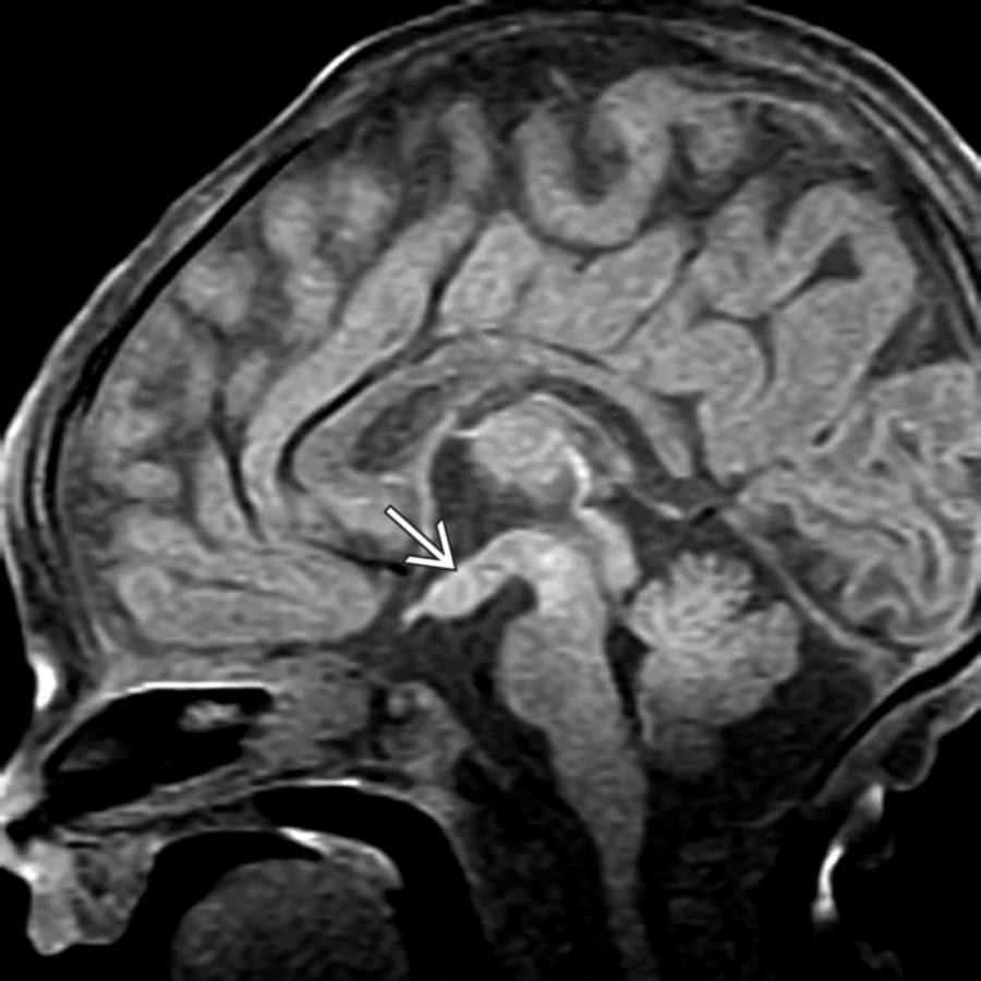 Sagittal T1 MR in a patient with duplicated pituitary glands shows a thickened floor of sella and fusion of the tuber cinereum and mammillary bodies (tuberomammillary fusion) . Note the absence of a midline sella turcica and pituitary infundibulum.