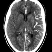 A 56-year-old man with > 70% stenosis of his proximal left cervical internal carotid artery (ICA) underwent carotid endarterectomy. A few hours after surgery, he became acutely confused and developed right-sided weakness. Perfusion source image shows markedly increased vasculature in the left hemisphere .