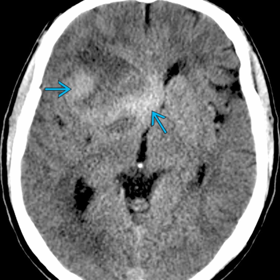 Axial NECT shows a heterogeneous mass causing a seizure in the right frontal lobe extending to the basal ganglia with midline shift. There are areas of hyperdensity  suggesting a high-grade neoplasm. This was a glioblastoma at biopsy.