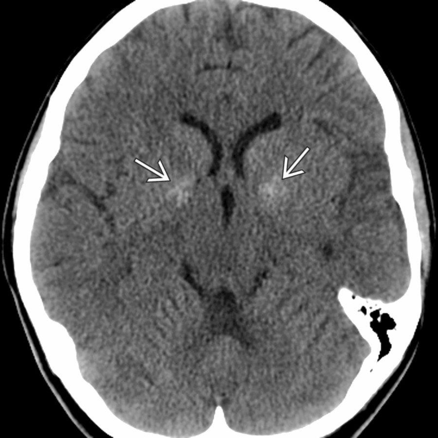 Axial NECT in a teenager shows bilateral GP  Ca⁺⁺, a rare finding in patients < 30 years.