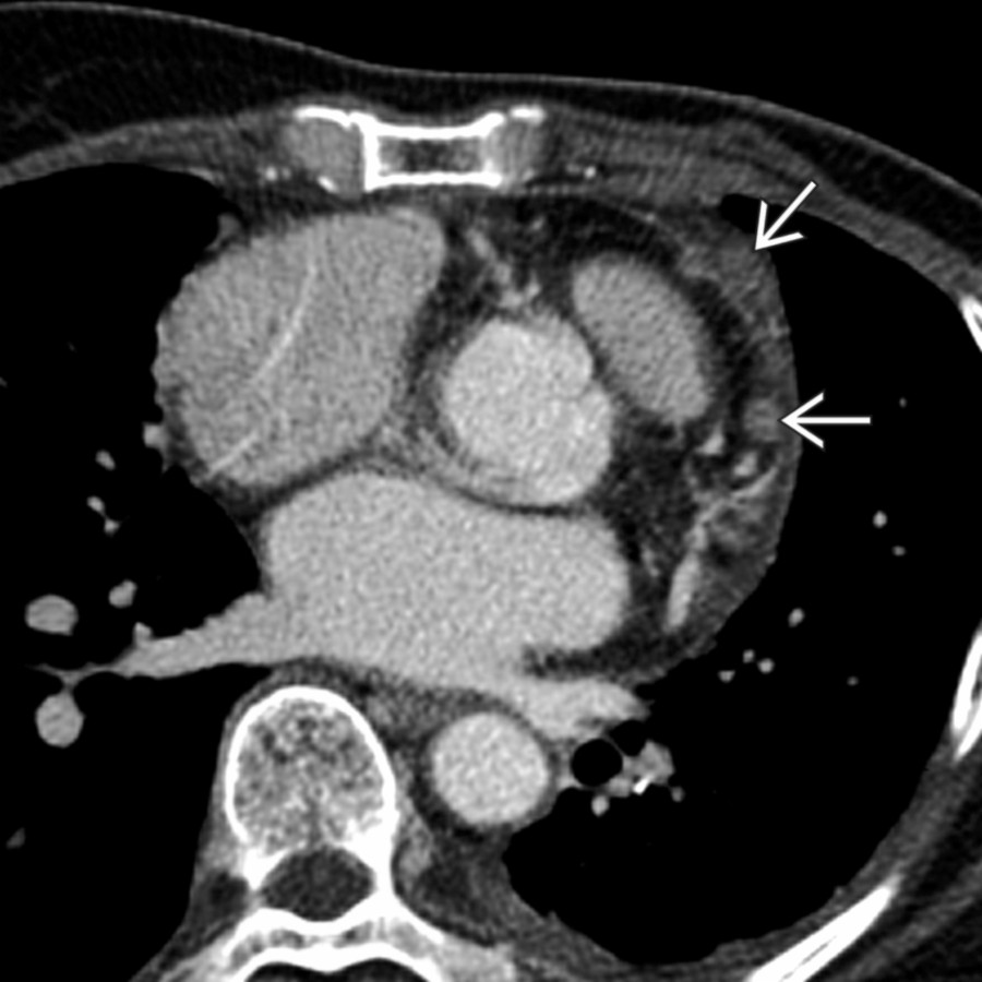 Axial CECT shows nodular, enhancing pericardial masses  in a patient with known metastatic lung cancer. These can present with hemopericardium.