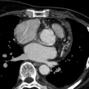 Axial CECT shows nodular, enhancing pericardial masses  in a patient with known metastatic lung cancer. These can present with hemopericardium.