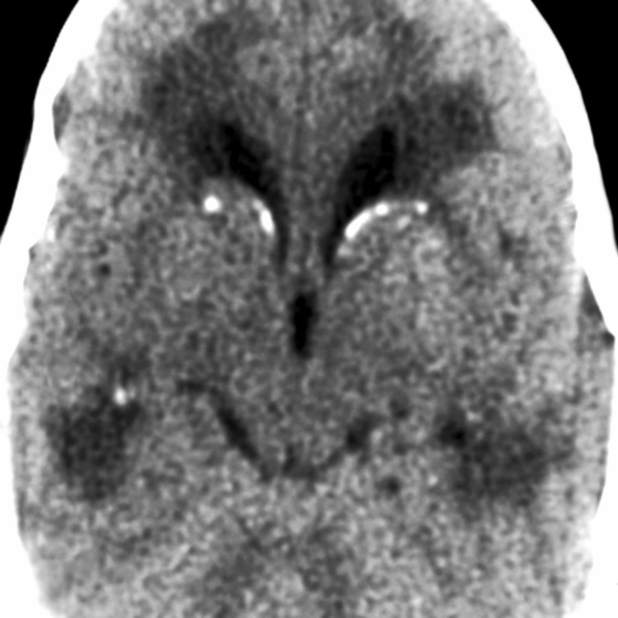Axial NECT shows periventricular & BG Ca⁺⁺. Periventricular calcifications, ventriculomegaly, & microcephaly strongly suggest congenital CMV infection.