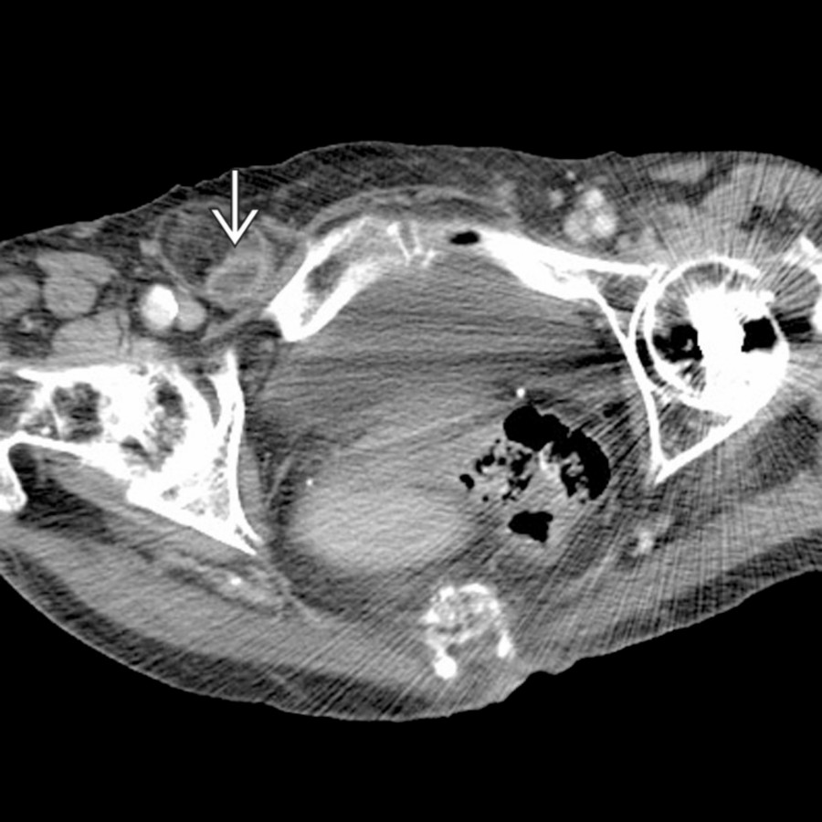 Axial CECT shows a loop of thickened, hyperemic bowel  herniating into the right groin medial to the femoral vessels.