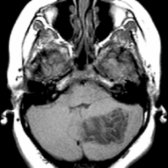 Axial T1 MR shows a striated appearance of extremely low-signal dysplastic gangliocytoma, a.k.a. Lhermitte-Duclos disease. The gyri  are in disarray.