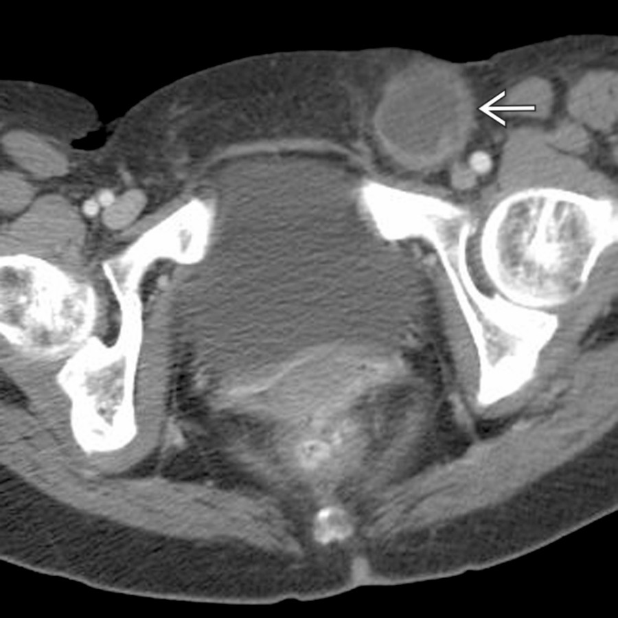 Axial CECT shows a left-sided femoral hernia , with the herniated bowel just medial to the femoral vessels.