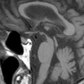 Sagittal T1WI MR in a patient with progressive supranuclear palsy shows marked atrophy of the midbrain  relative to pons. There is upper concavity of the midbrain tegmentum  with a "penguin" or "hummingbird" sign and thinning of superior tectum .