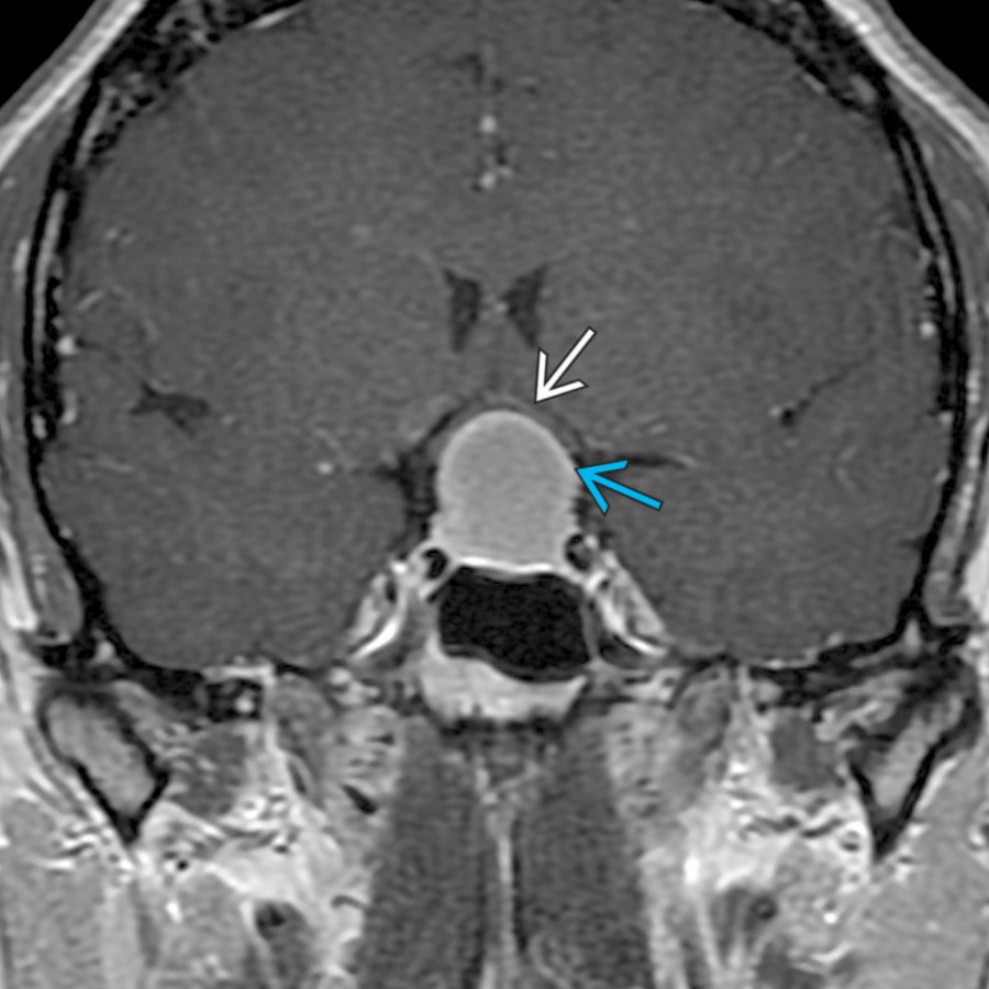 Coronal T1 C+ MR shows a sellar and suprasellar RCC with a claw sign of compressed pituitary gland  surrounding the mass. Note the superior displacement of the optic chiasm  draped over the mass in this patient with visual changes.