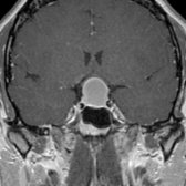 Coronal T1 C+ MR shows a sellar and suprasellar RCC with a claw sign of compressed pituitary gland  surrounding the mass. Note the superior displacement of the optic chiasm  draped over the mass in this patient with visual changes.